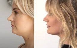 coolsculpting riyadh|CoolSculpting in Riyadh & Saudi Arabi .